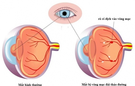 Bệnh võng mạc đái tháo đường